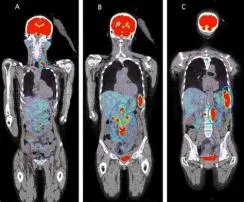 Can a pet scan miss a tumor?