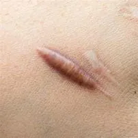 Why did scar turn black?