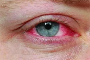 What causes pink eye?